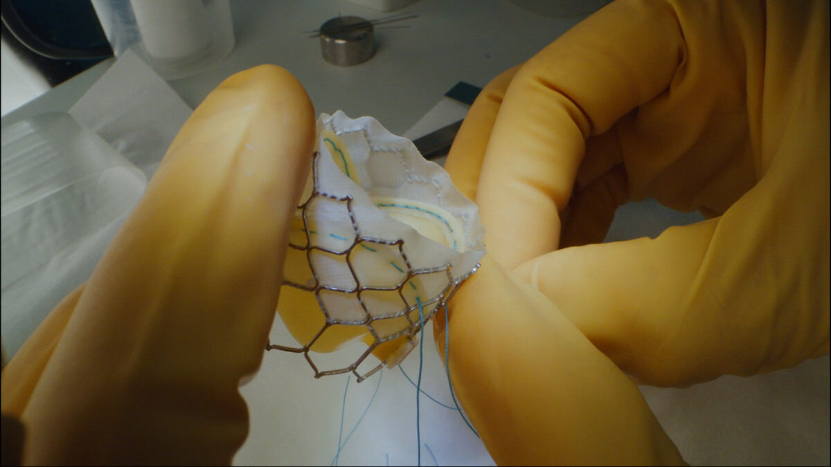 Sapien heart valve hand-sewing. The innovative Sapien 3 heart valve, used in TAVR heart valve replacement procedures, is hand-sewn and so advanced that it successfully treats aortic stenosis without requiring open-heart surgery.